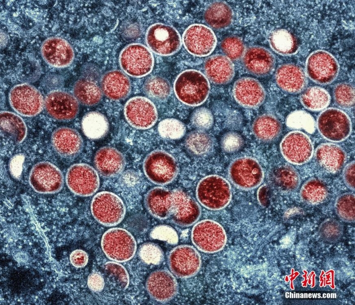 當(dāng)?shù)貢r(shí)間2022年7月26日，美國馬里蘭州，在實(shí)驗(yàn)室培養(yǎng)的感染細(xì)胞(棕色)中發(fā)現(xiàn)的猴痘顆粒(橙色)的彩色透射電子顯微圖。圖片來源：視覺中國