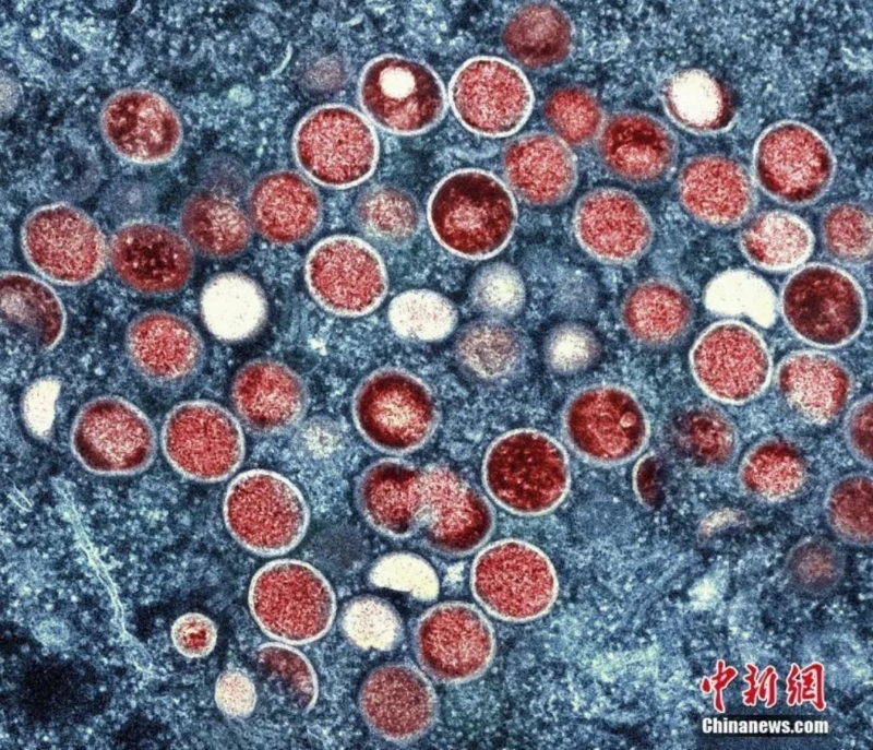 資料圖：猴痘顆粒的彩色透射電子顯微圖。.png